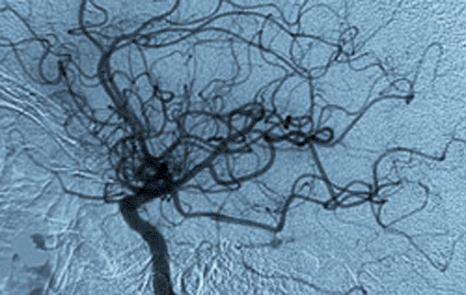 Image: Inhibition of the enzyme cPLA2 leads to collapsed vessels, stopping blood flow to the tumor (photo courtesy Washington University in St. Louis).